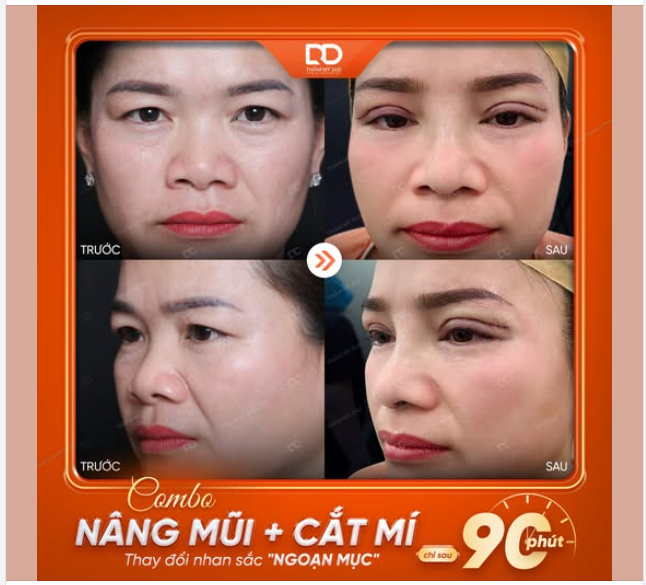 COMBO NÂNG MŨI + CẮT MÍ = THAY ĐỔI KHUÔN MẶT HOÀN HẢO