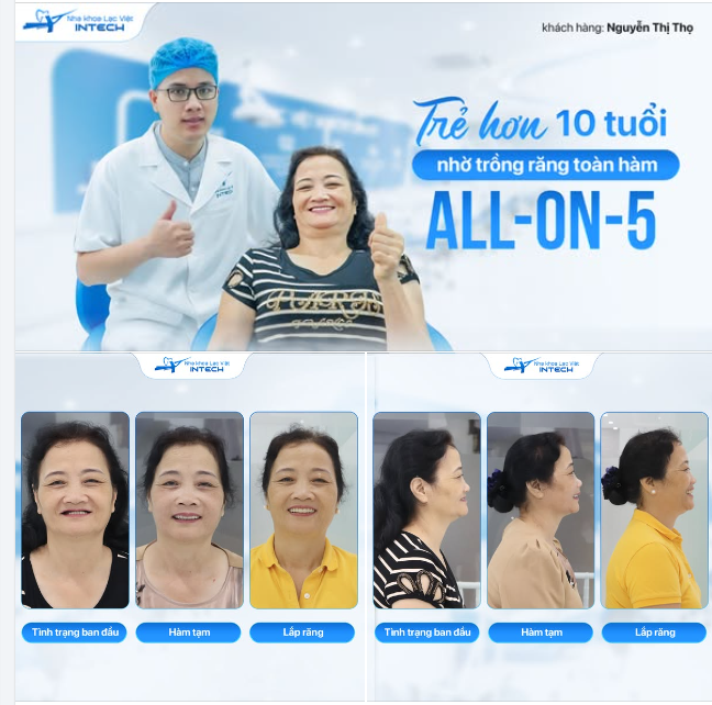 TRẺ RA 10 TUỔI NHỜ TRỒNG RĂNG TOÀN HÀM ALL-ON-5 KIỂM CHỨNG NGAY!