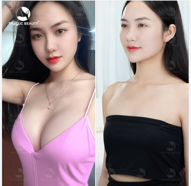 Nâng ngực Không đau. Hồi phục nhanh gấp 2 lần  7 ngày vào form dáng ngực như ý