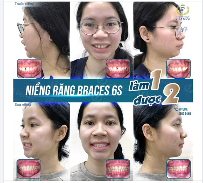 “RĂNG THƯA LỘNG GIÓ” – TỰ TI, THƯỜNG PHẢI LẤY TAY CHE MIỆNG KHI CƯỜI  NIỀNG RĂNG BRACES 6S – “LỘT XÁC NỤ CƯỜI” RẠNG RỠ, TỰ TIN