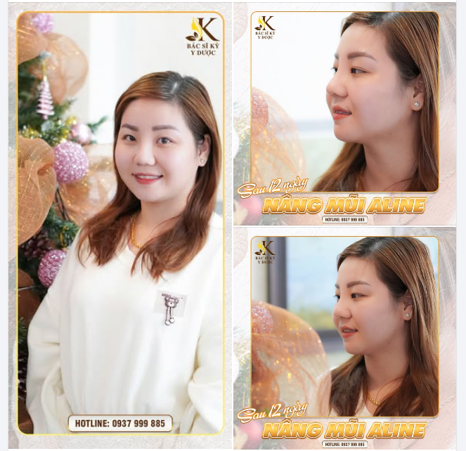 DÁNG MŨI HOÀN HẢO SAU 12 NGÀY NÂNG MŨI ALINE