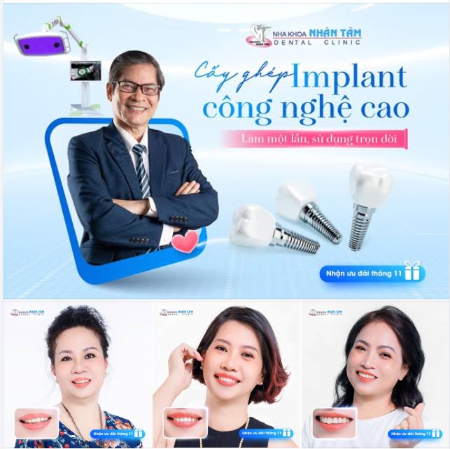 Cấy ghép Implant công nghệ cao - Trải nghiệm dịch vụ đẳng cấp tại Nha khoa Nhân Tâm