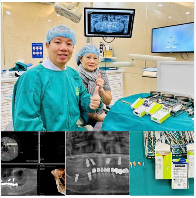 CẮM IMPLANT - ĐẦU TƯ LÂU DÀI CHO SỨC KHOẺ