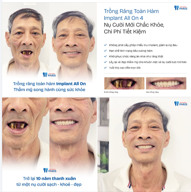 Sẵn sàng đón Tết với nụ cười tự tin rạng rỡ, thoải mái ăn nhai