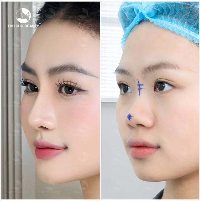 Một khuôn mặt chỉ sau nâng mũi đã tạo nên sự khác biệt rõ nét