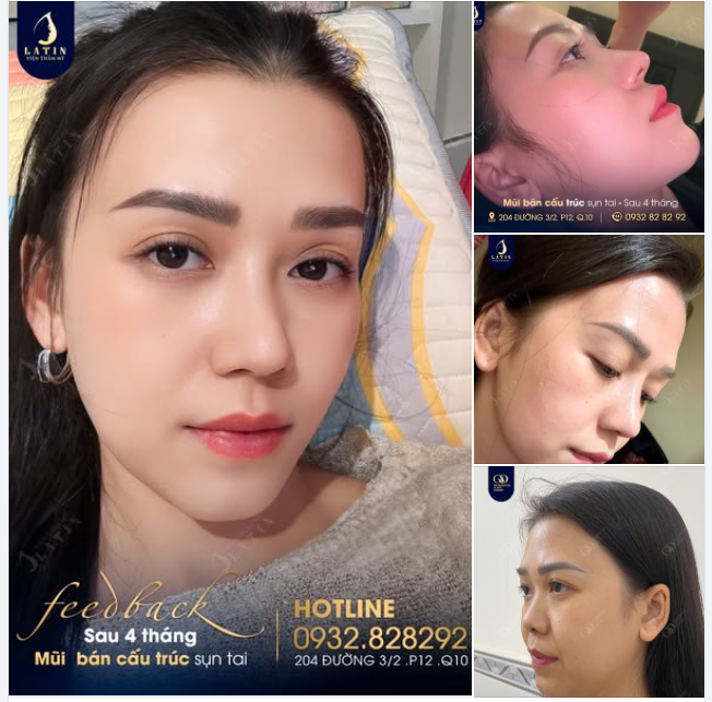 Mũi bán cấu trúc sụn tai kết hợp lót megaderm sau 4 tháng
