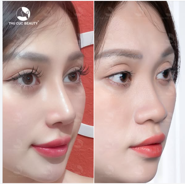 Sụn mũi cao cấp. Không gây biến chứng  5 ngày tháo nẹp. Không nghỉ dưỡng