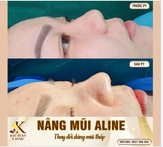 NÂNG MŨI ALINE – ĐẸP NGAY SAU KHI THỰC HIỆN