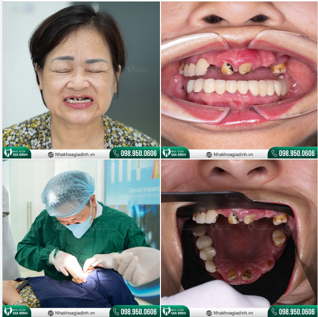 "GIẢI CỨU"MẤT RĂNG CÙNG NHA KHOA GIA ĐÌNH