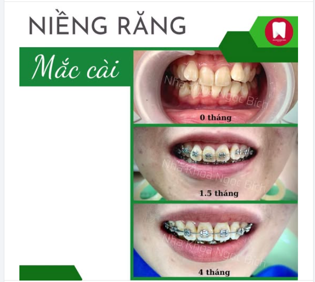 NIỀNG RĂNG MẮC CÀI KIM LOẠI - AN TOÀN MÀ HIỆU QUẢ