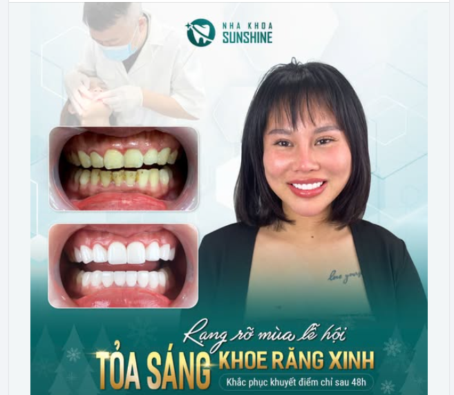 BỌC RĂNG SỨ là giải pháp lý tưởng nhất giúp cải thiện hình thể răng, đảm bảo 4 yếu tố "đẹp" dịp lễ hội này:
