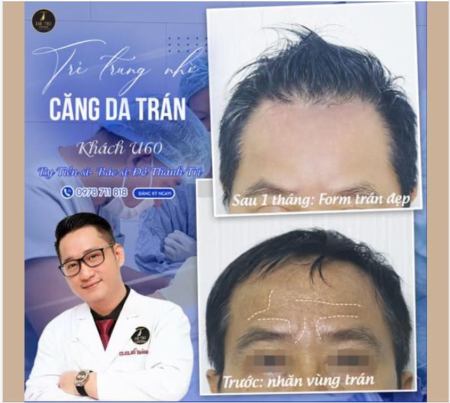 Tình cờ tìm "Địa Chỉ Căng Da Trán Uy Tín", Google gợi ý thế này: