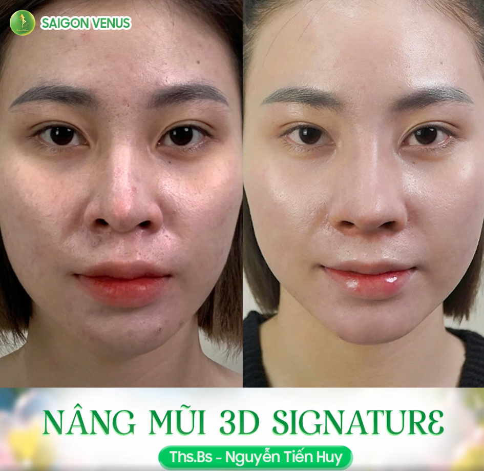 KHÁCH HÀNG THAY ĐỔI SAU KHI NÂNG MŨI 3D SIGNATURE