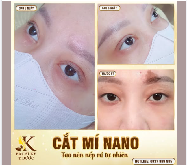 Cắt Mí Trên Nano - Lấy Lại Sự Tự Tin
