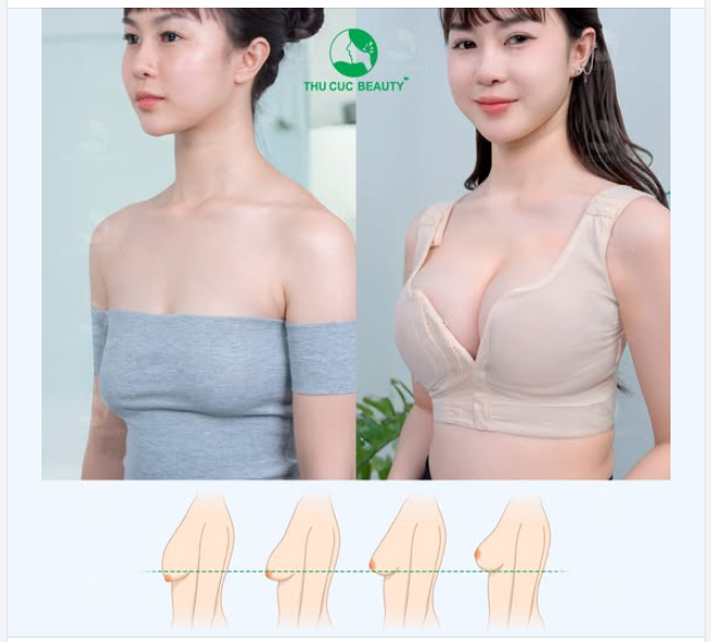 Hot mom Chi Bé tin chọn nâng ngực tại Thu Cúc, còn bạn?
