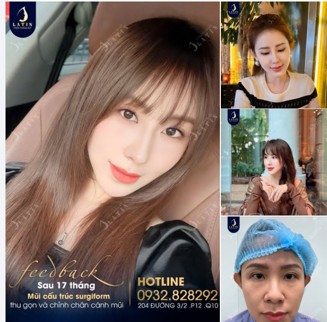 Mũi cấu trúc surgiform cho chị khách thích cao nét nhưng vẫn kín đáo tự nhiên