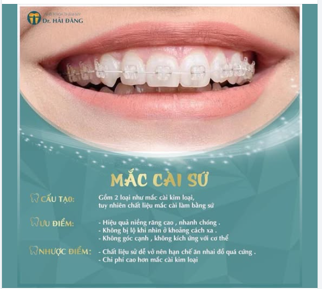 MẮC CÀI SỨ LỰA CHỌN THẨM MỸ CAO CẤP TRONG CHỈNH NHA