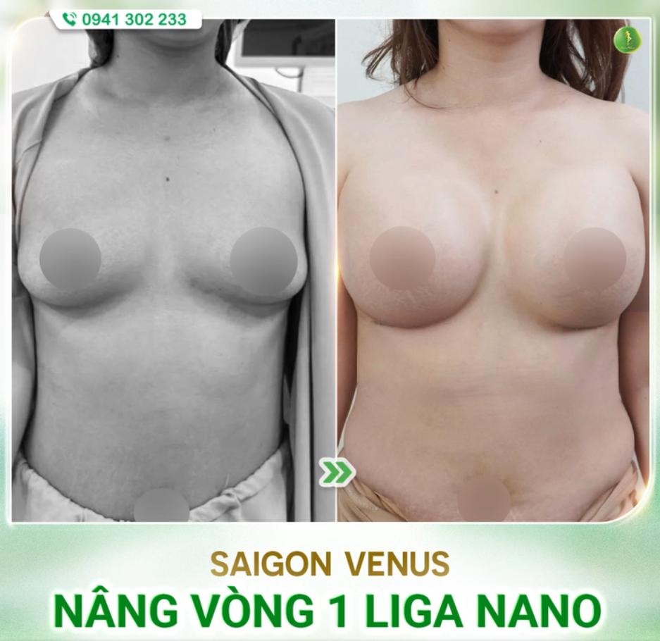 HÀNH TRÌNH TÌM LẠI VẺ ĐẸP TỰ TIN VỚI CÔNG NGHỆ LIGA NANO