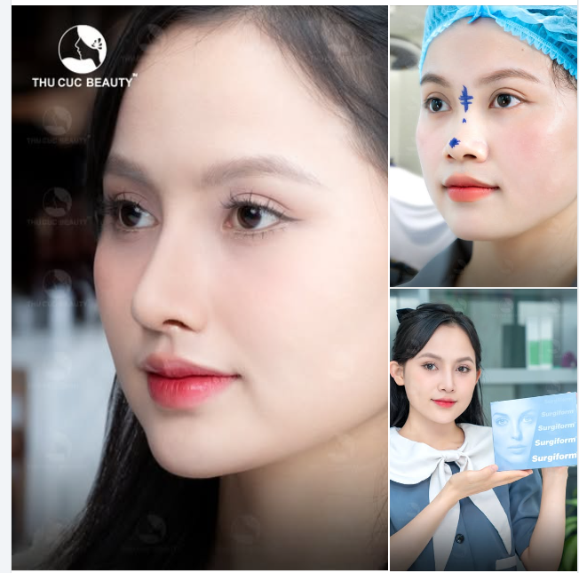 Say bye tình trạng mũi thấp/gồ/hếch