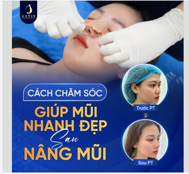 CÁCH CHĂM SÓC GIÚP MŨI NHANH LÀNH, ĐẸP SAU NÂNG MŨI
