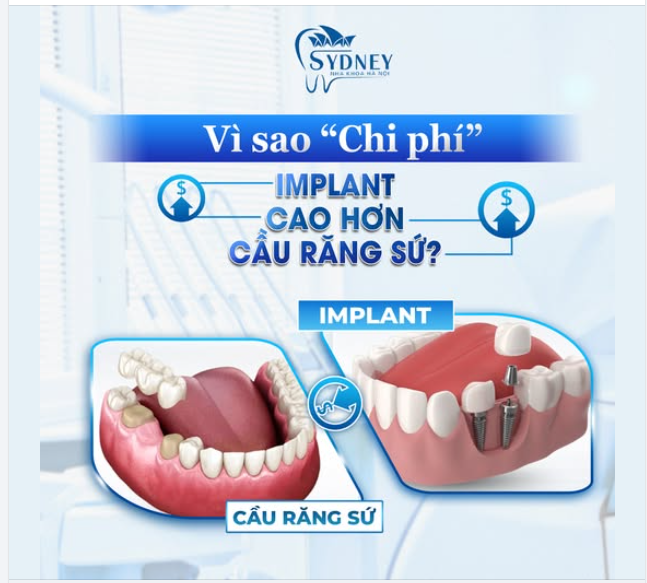 VÌ SAO IMPLANT CÓ CHI PHÍ CAO HƠN CẦU RĂNG SỨ?