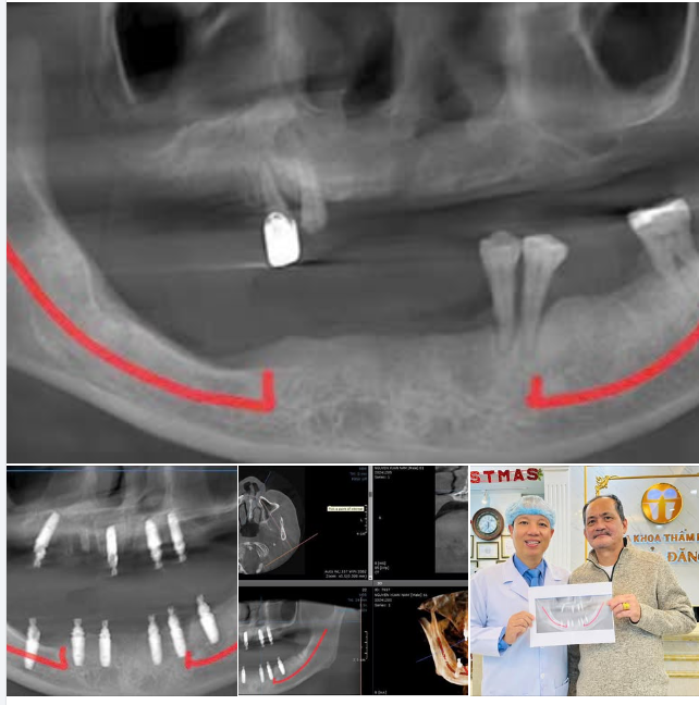 GIẢI PHÁP IMPLANT TOÀN HÀM ALL ON 4 VÀ ALL ON 6 CHO NGƯỜI MẤT RĂNG TOÀN HÀM