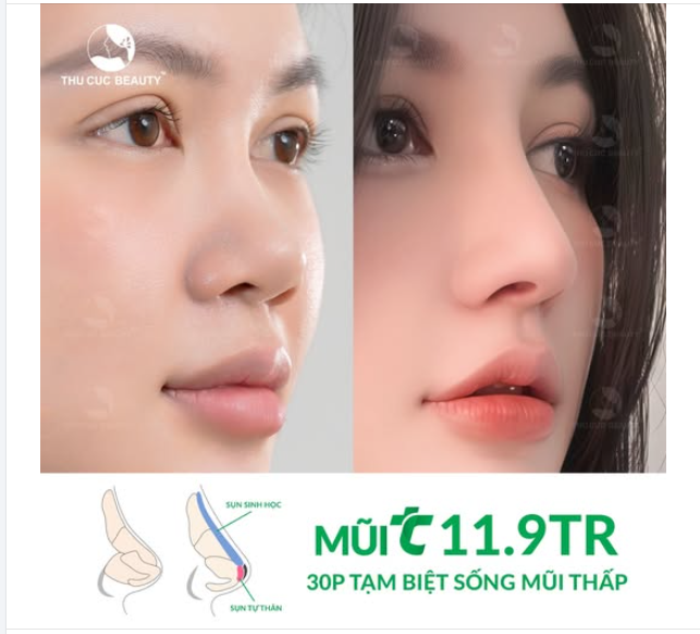 Sở hữu dáng mũi tự nhiên, cân đối sau 30P  Sụn mũi chính hãng. Hạn chế bóng đỏ/ lộ sụn