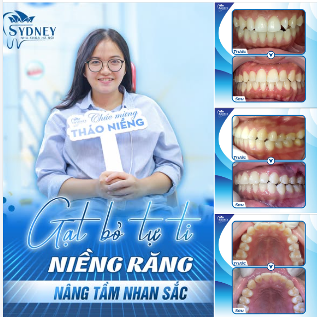 GẠT BỎ TỰ TI - NIỀNG RĂNG NÂNG TẦM NHAN SẮC