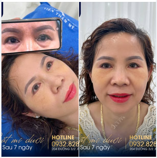 Trẻ hơn chục tuổi sau 7 ngày CẮT MÍ DƯỚI