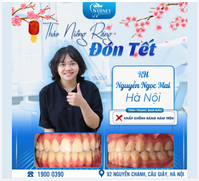 THÁO NIỀNG RĂNG ĐÓN TẾT CÙNG KH. NGỌC MAI