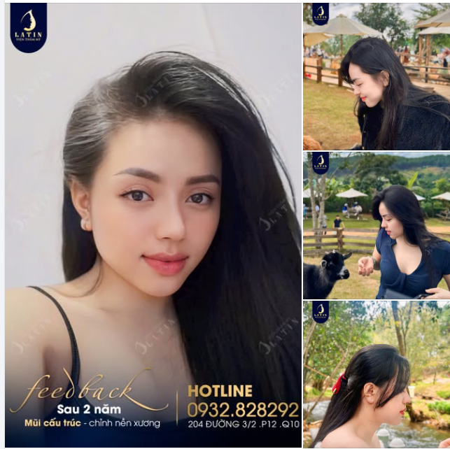 Đầu tháng với feedback xinh yêu sau 2 năm nâng mũi từ em gái
