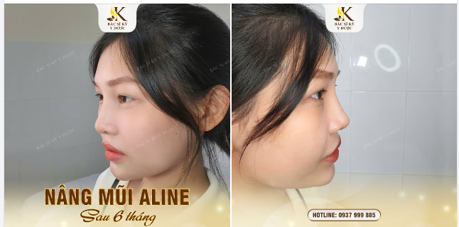 KẾT QUẢ NÂNG MŨI ALINE SAU 6 THÁNG - ĐẸP TỰ NHIÊN, NÂNG CAO THẦN THÁI