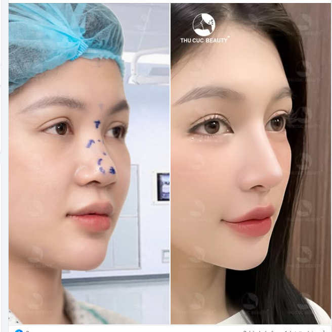 Mũi thấp tẹt được cải thiện chỉ sau Nâng Mũi TC