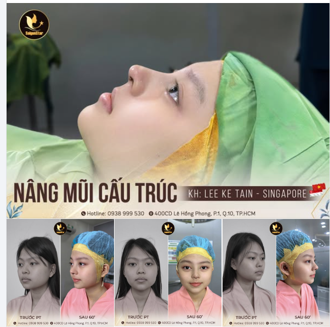 NÂNG MŨI CẤU TRÚC - ĐẸP KỊP ĐÓN GIÁNG SINH - MỪNG NĂM MỚI