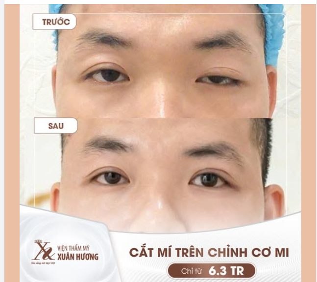 Nhược cơ mi khiến mắt sụp gây mất thẩm mỹ, hạn chế tầm nhìn?