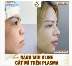 Combo NÂNG MŨI ALINE + CẮT MÍ TRÊN PLASMA - Kết quả bền vững sau 1 năm Chính tay bác sĩ Kỳ Y Dược thực hiện.