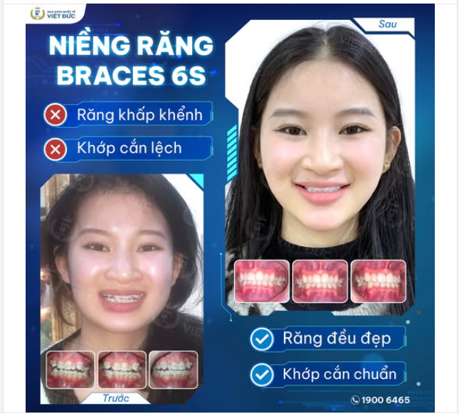 MỪNG NGÀY THÁO NIỀNG: KHÁCH HÀNG LƯU THỊ THU PHƯƠNG️