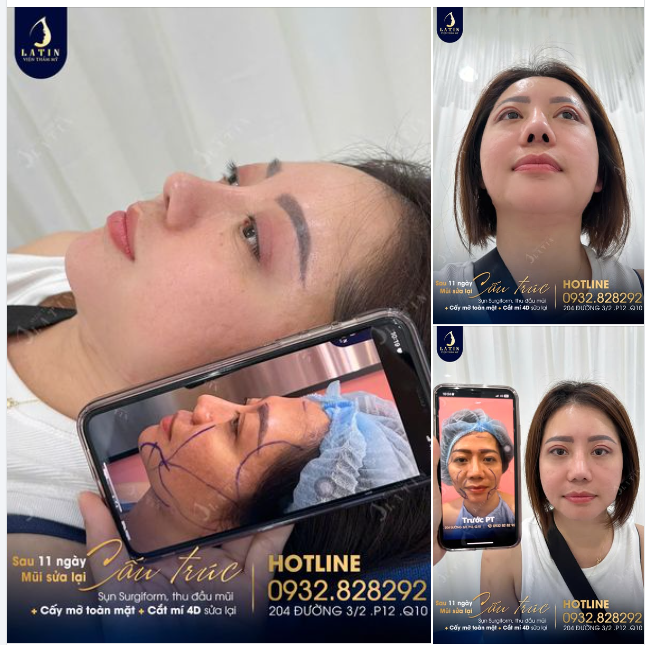 HÀNH TRÌNH BIẾN HÌNH SAU 11 NGÀY CHO CHỊ GÁI VIỆT KIỀU MỸ