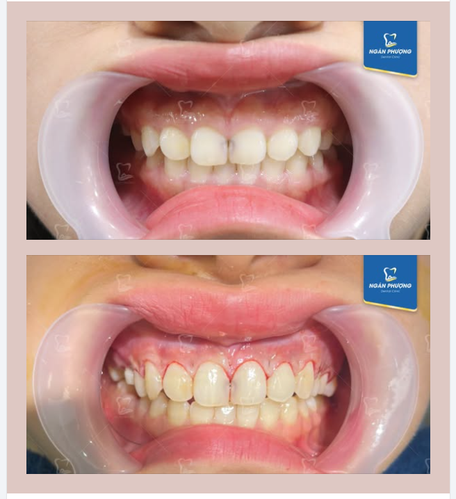Hình ảnh răng trước và sau cắt lợi của chị Lê Hằng. Cắt lợi giúp hình thể răng đẹp hơn và khắc phục cười hở lợi.