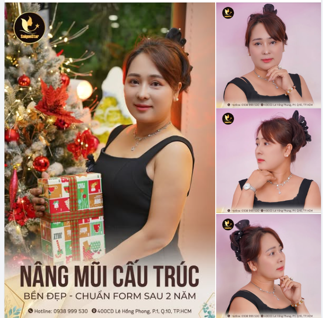 Feedback mũi bền đẹp sau 2 năm nâng mũi cấu trúc tại Saigon Star!!!