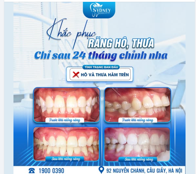 KHẮC PHỤC RĂNG HÔ, THƯA SAU 24 THÁNG CHỈNH NHA