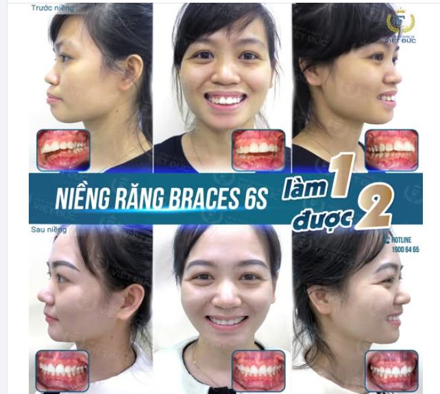 MỪNG NGÀY THÁO NIỀNG: KHÁCH HÀNG NGUYỄN THỊ TỚI  NHƯ THÀNH NGƯỜI KHÁC CHỈ SAU 2 NĂM NIỀNG RĂNG