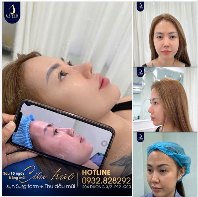 Mũi cấu trúc sửa lại sau 10 ngày cho em gái
