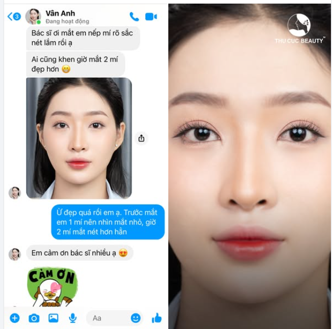 Cùng xem feedback siêu chất lượng của hotgirl Vân Anh sau khi có được đôi mắt 2 mí ưng ý.
