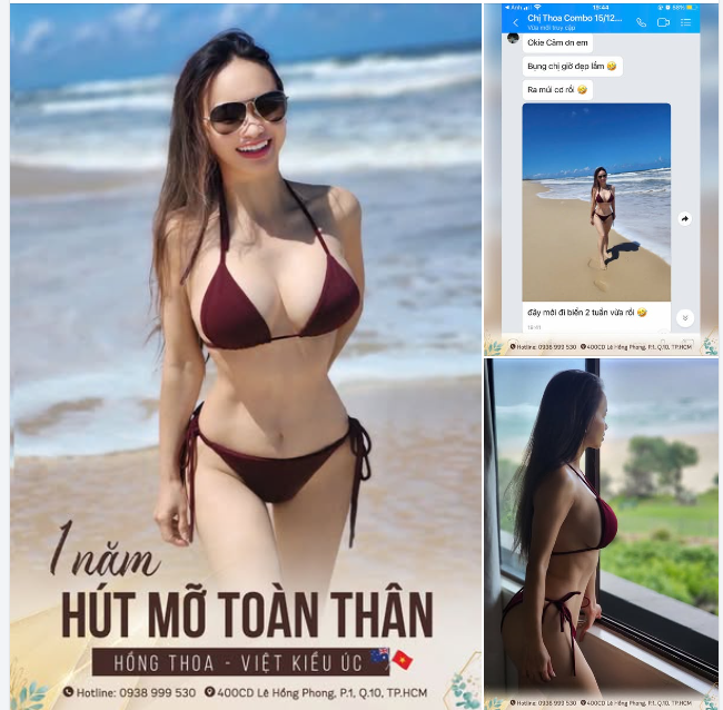 Feedback Kết quả "mê mệt" vòng eo thon gọn, cơ bụng săn chắc, không chút mỡ thừa sau 1 năm "độ body" cùng COMBO HÚT MỠ VASER LIPO + CĂNG DA BỤNG