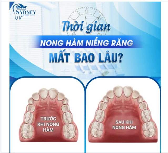 THỜI GIAN NONG HÀM MẤT BAO LÂU?