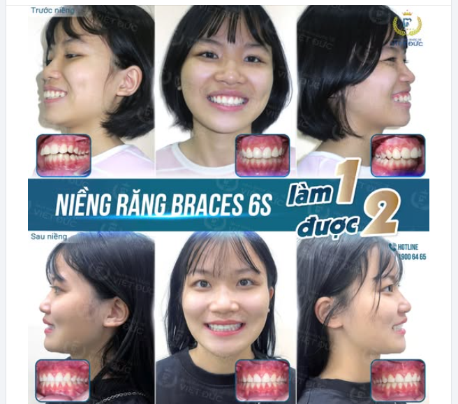NIỀNG RĂNG BÁC SĨ MẬU ĐÃ GIÚP TÔI THAY ĐỔI THẾ NÀO