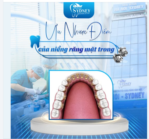 ƯU NHƯỢC ĐIỂM CỦA NIỀNG RĂNG MẶT TRONG