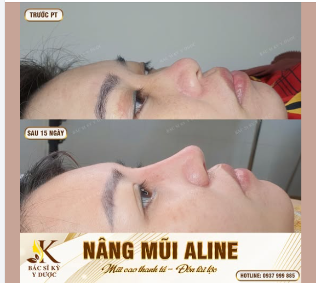 Oder một chiếc mũi ALINE sau 15 ngày đẹp xuất sắc như chị khách nhà Bác sĩ Kỳ Y Dược đi ạ!!