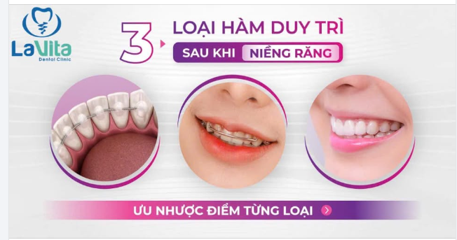 TẠI SAO CẦN ĐEO HÀM DUY TRÌ SAU KHI NIỀNG RĂNG? CÓ NHỮNG LOẠI HÀM DUY TRÌ NÀO?